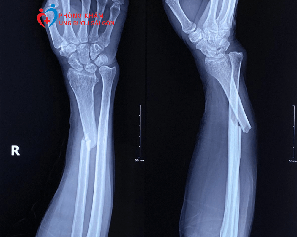 Kỹ Thuật Chụp X Quang Xương Cẳng Tay Thẳng Nghiêng Mà Bạn Nên Biết