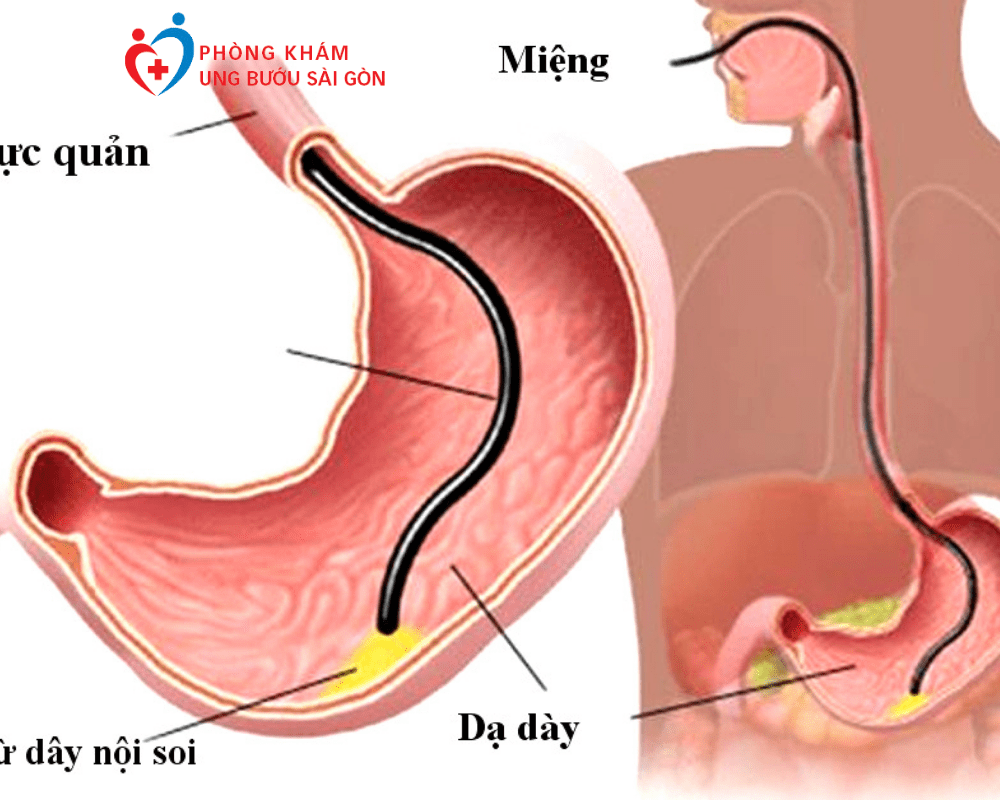 Những Điều Quan Trọng Mà Bạn Cần Phải Biết Về Nội Soi Dạ Dày