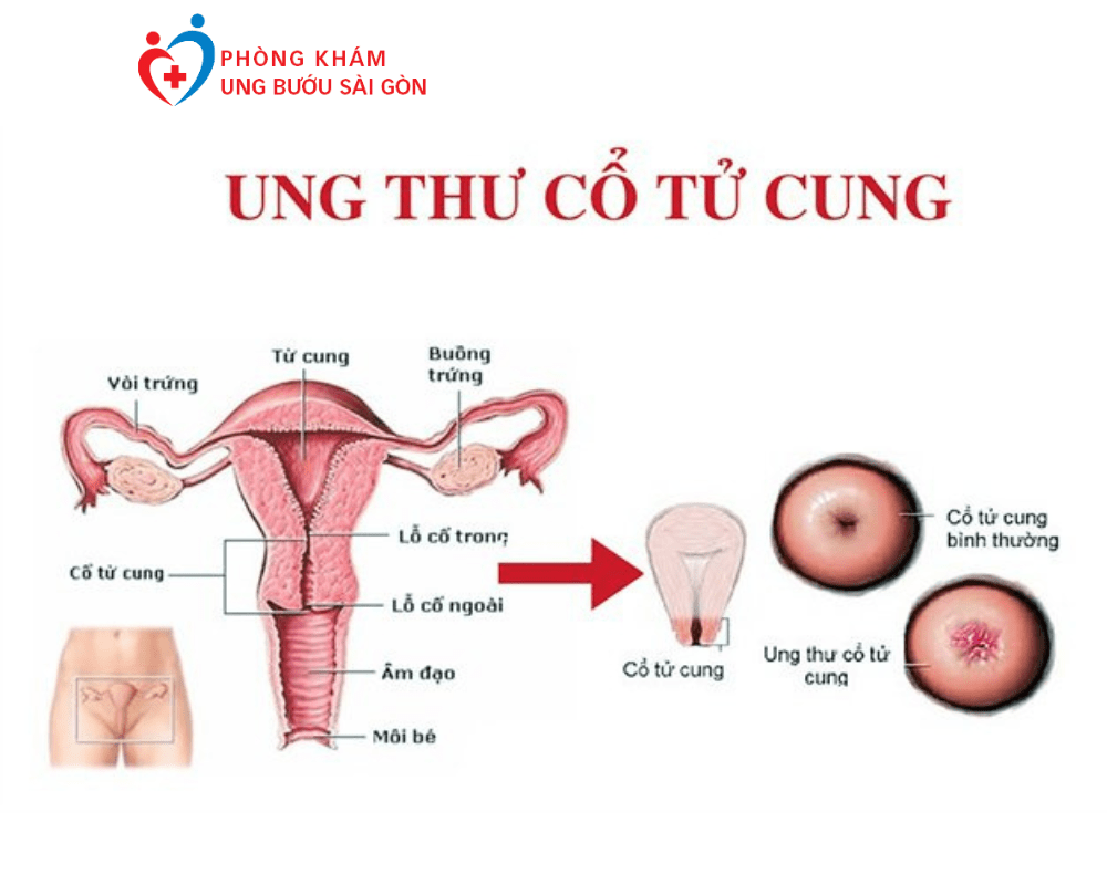 Ung thư cổ tử cung: Nguyên nhân, triệu chứng và điều trị